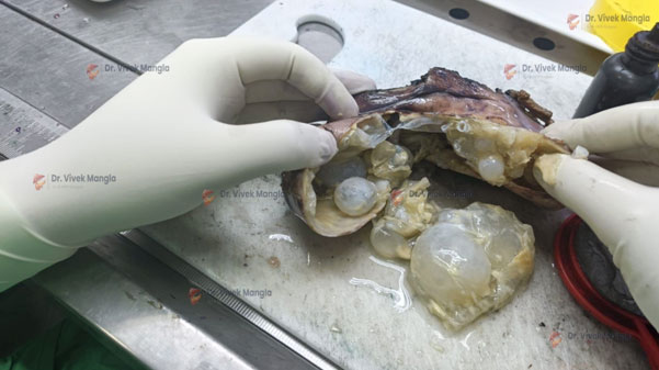 Hydatid Cyst of Liver: Causes, Symptoms, Diagnosis & Treatment