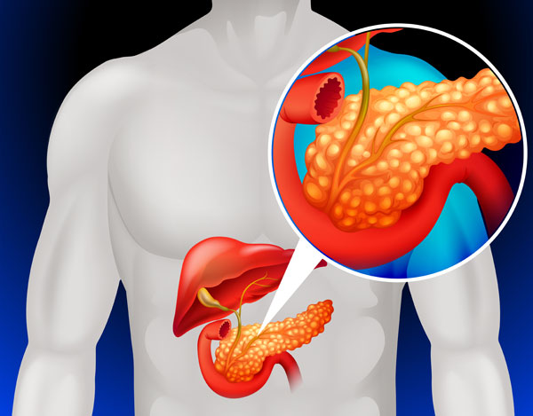 Busting Common Myths about Gallbladder Cancer: Facts You Should Know