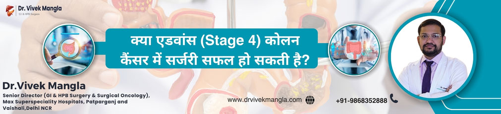 क्या एडवांस (Stage 4) कोलन कैंसर में सर्जरी सफल हो सकती है?
