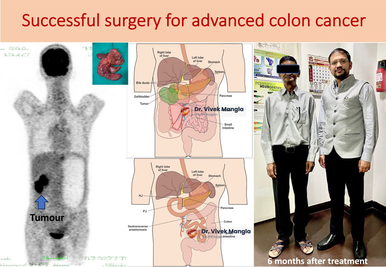 Successful complex surgery for advanced colon cancer