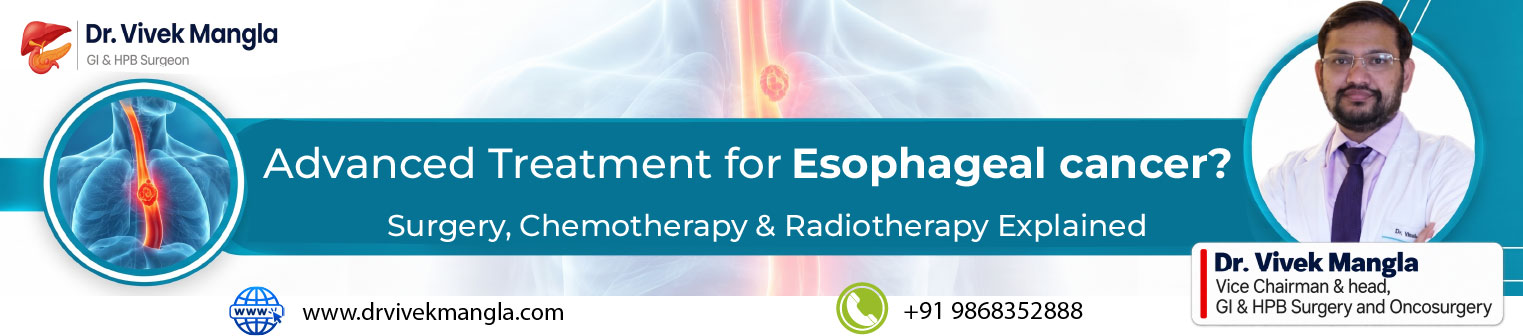 What Is the Best Treatment for Esophageal Cancer? Surgery, Chemotherapy & Radiotherapy Explained